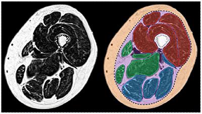 Overview of MR Image Segmentation Strategies in Neuromuscular Disorders